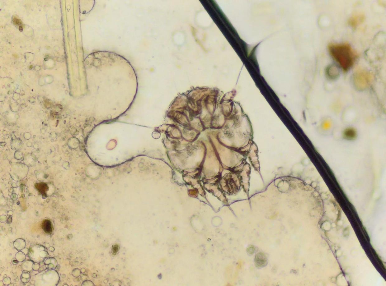 Scabies Outbreak at Immigrant Detention Facility in Aurora