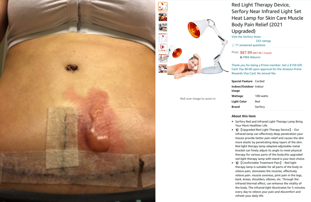 A third-degree burn alongside a Amazon listing for the light therapy lamp